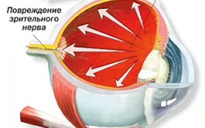 Глаукома