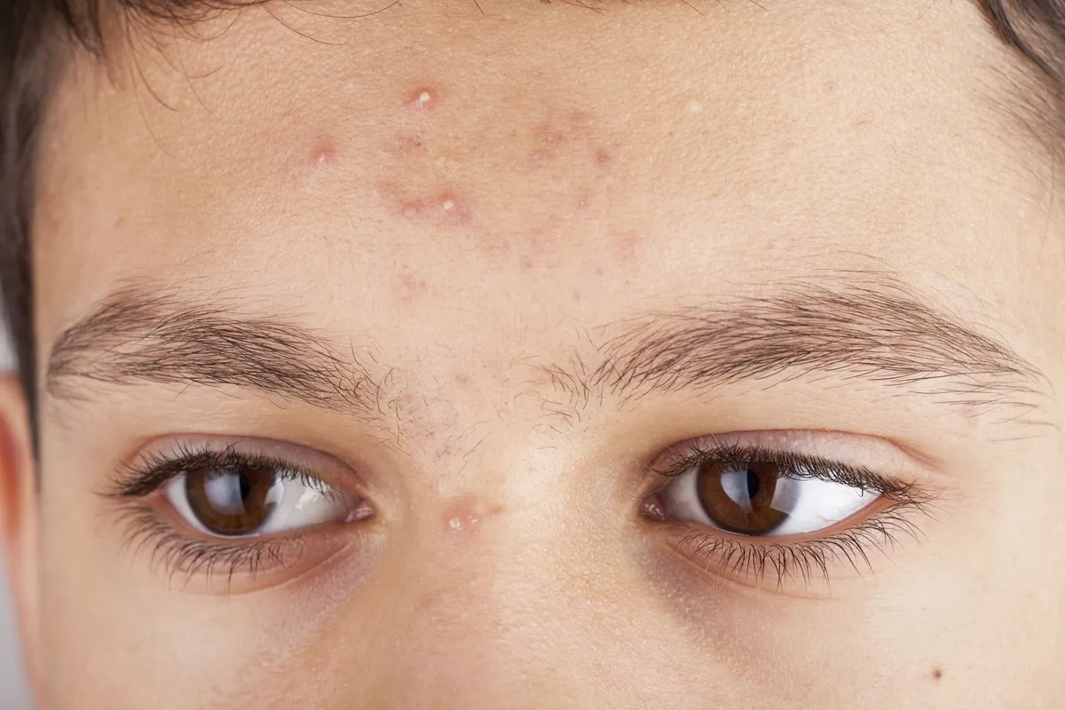 Що таке акне і як його вилікувати?