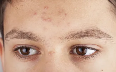 Что такое акне и как его вылечить?