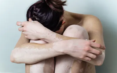 Методы лечения витилиго