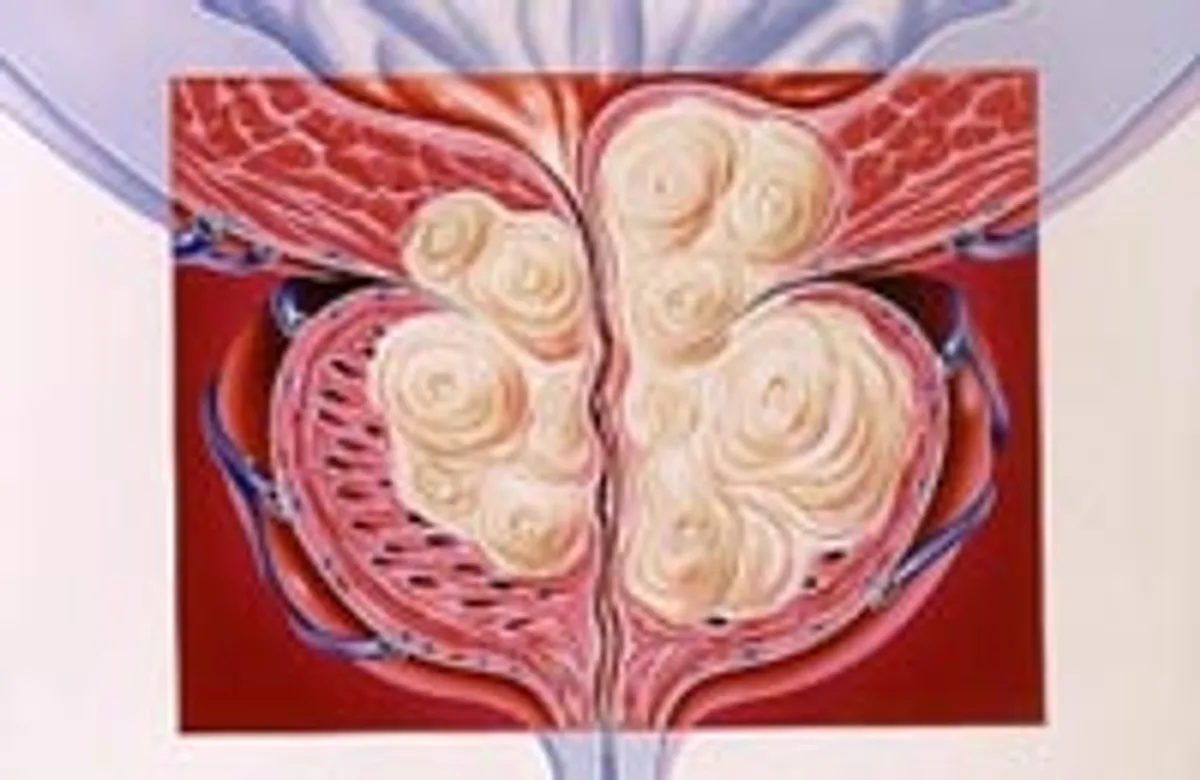 Угроза мужскому здоровью