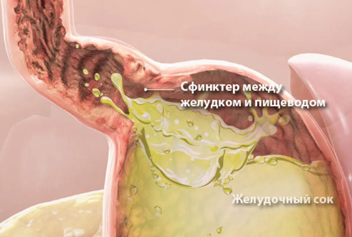 Изжога: лечить или игнорировать?