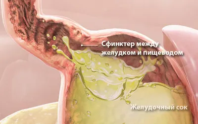 Изжога: лечить или игнорировать?