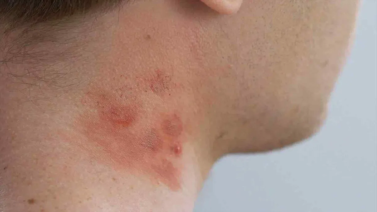 Откуда берется контактный дерматит?