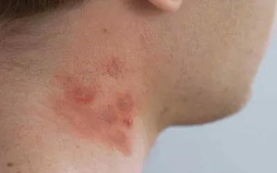 Откуда берется контактный дерматит?