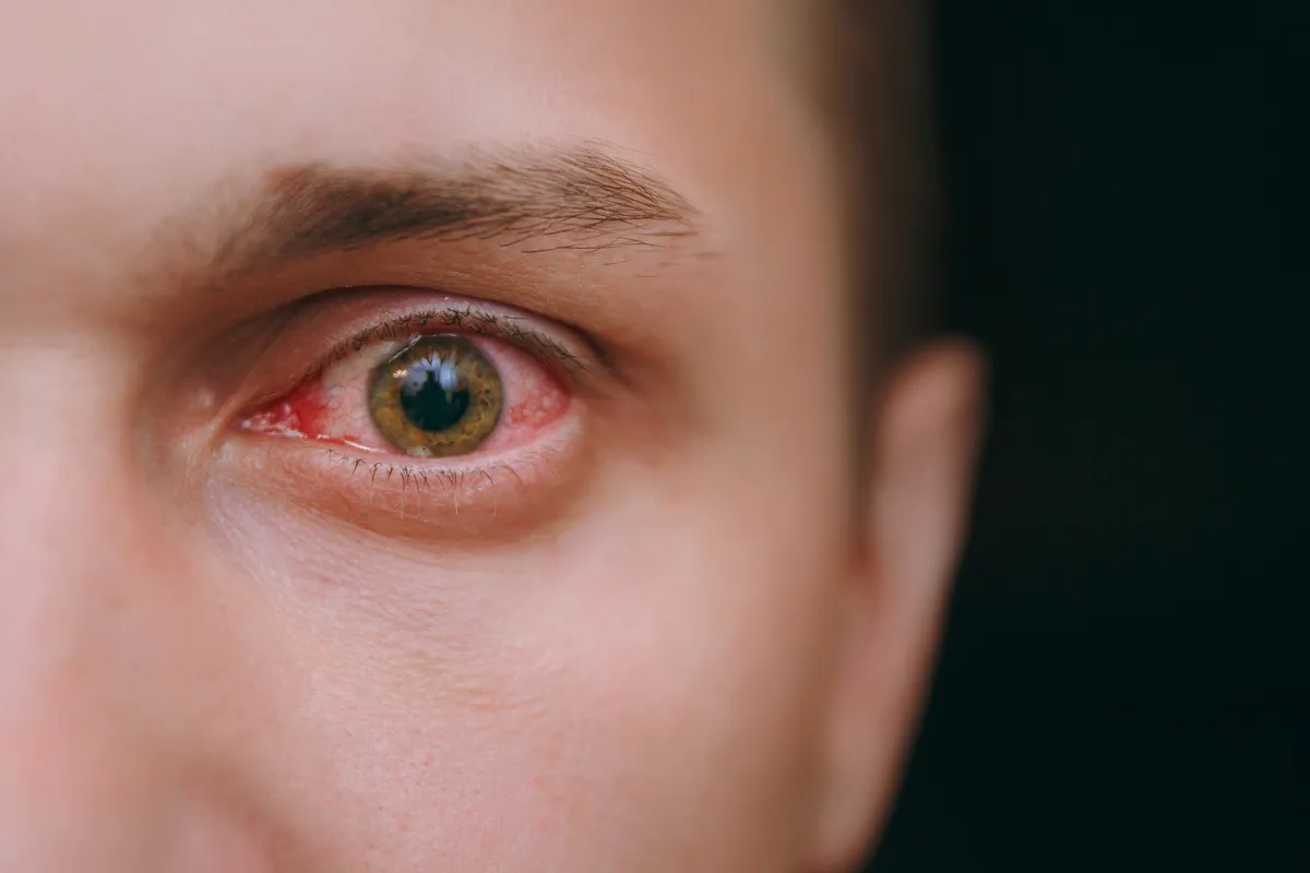 Чим загрожує нестача рибофлавіну?