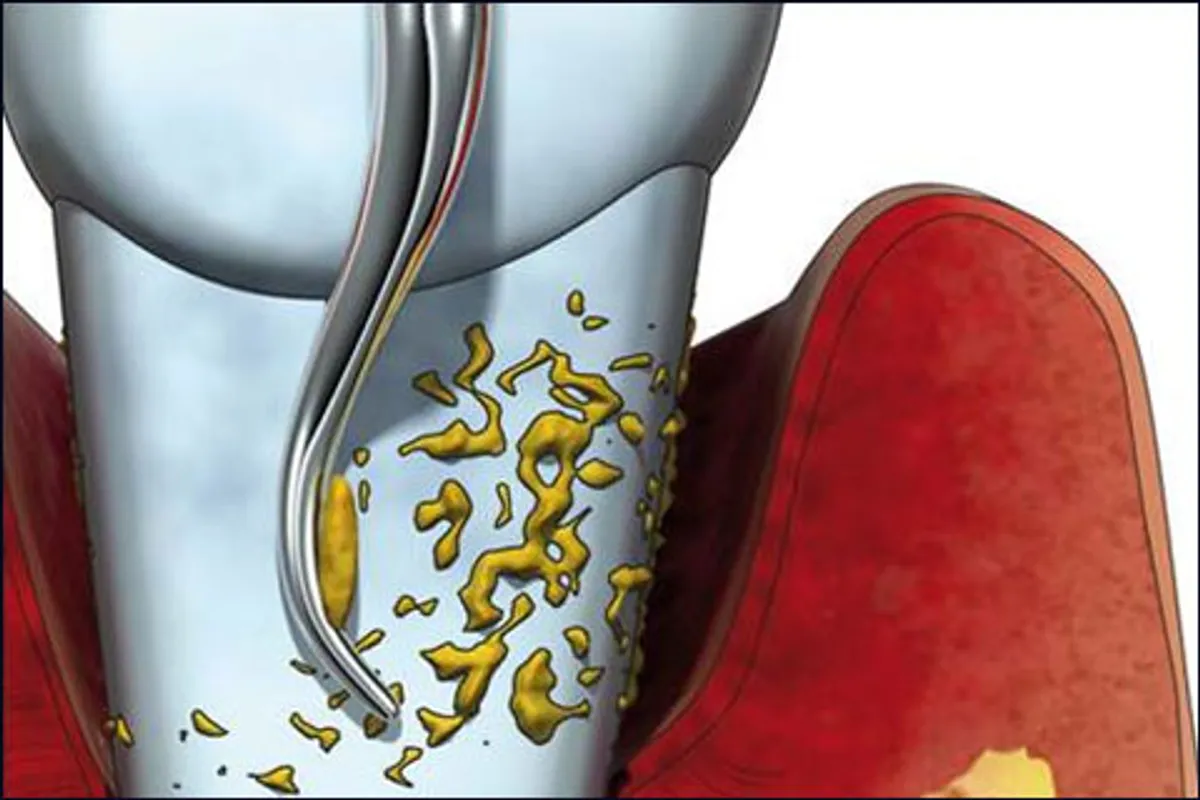 Болезни десен