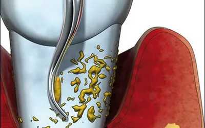 Болезни десен