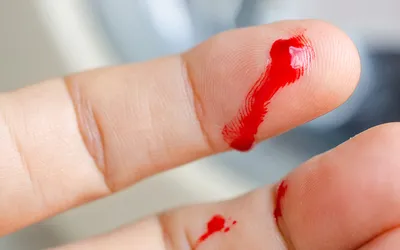 Що таке гемофілія: симптоми, причини, лікування