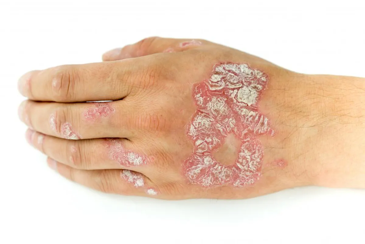 Главные разновидности псориаза