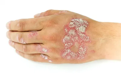 Главные разновидности псориаза