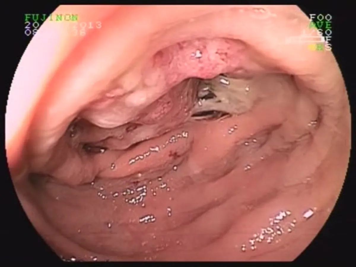 Болить живіт, болить низ живота, біль в правому підребер'ї, здуття живота, печія це типові скарги з якими до нас звертаються пацієнти.
