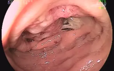 Болить живіт, болить низ живота, біль в правому підребер'ї, здуття живота, печія це типові скарги з якими до нас звертаються пацієнти.