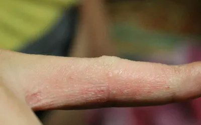 Що таке дисгідроз і що з ним робити?