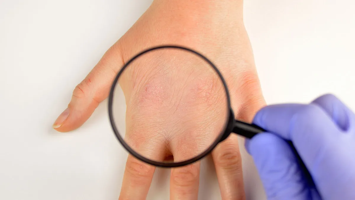 Дерматит: виды, причины, лечение