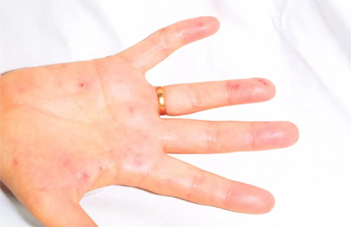 5 главных причин эндокардита