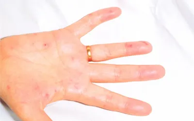 5 главных причин эндокардита