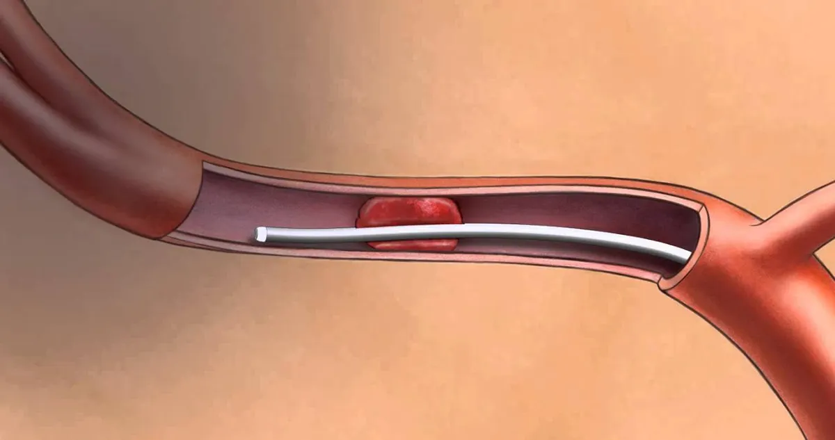 Лечение и реабилитация после инсульта