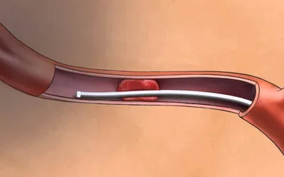 Лечение и реабилитация после инсульта