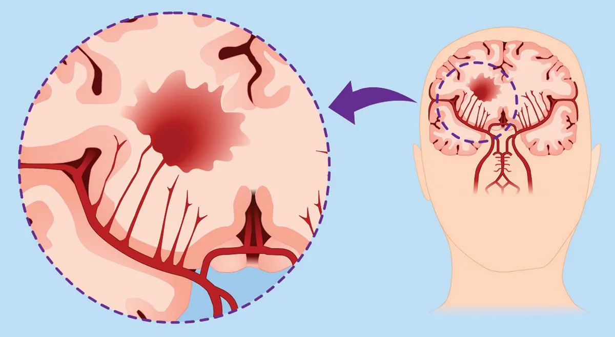 Как вовремя распознать признаки инсульта?