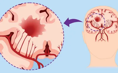Как вовремя распознать признаки инсульта?