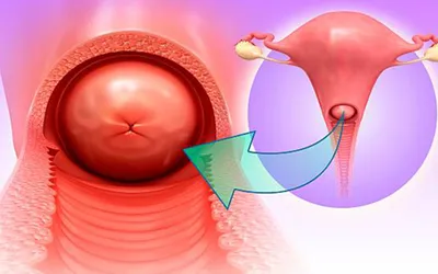 Що таке цервіцит і як його лікувати?