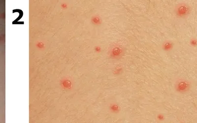 Как выглядит ветрянка?