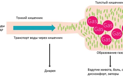 FODMAP диета при синдроме раздраженного кишечника