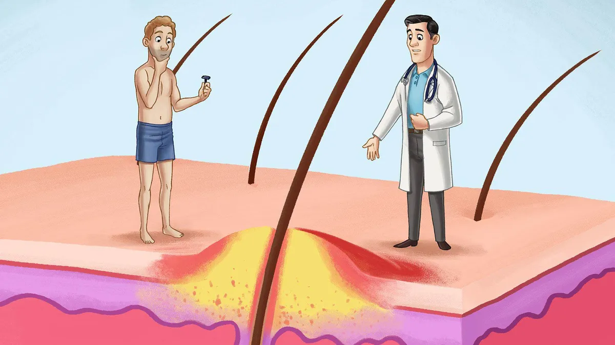 Що таке фолікуліт і як від нього позбутися?