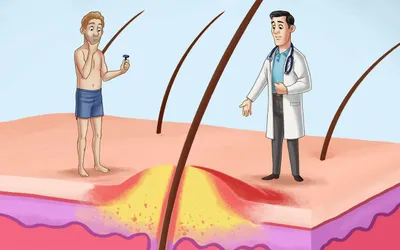 Що таке фолікуліт і як від нього позбутися?