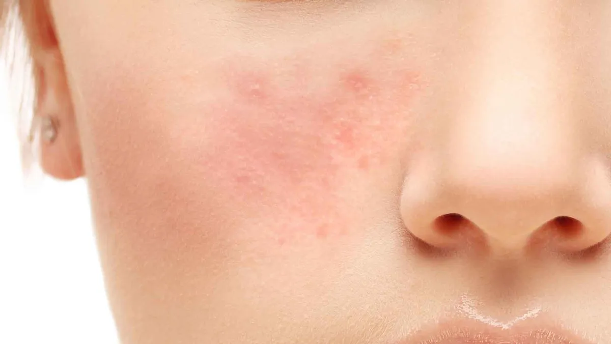 Розацеа: симптомы, причины, методы лечения