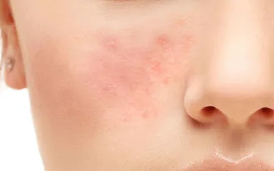 Розацеа: симптомы, причины, методы лечения